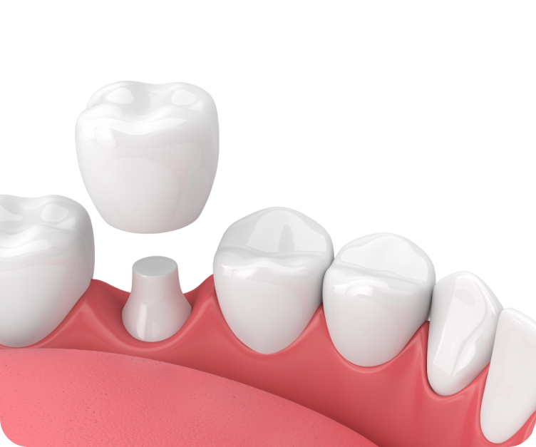Коронка из диоксида циркония — один из самых популярных видов протезирования зубов. Она отличается высокой прочностью, долговечностью и эстетичностью.<br>
 <br>
 Диоксид циркония биосовместимый материал, который идеально подходит для восстановления зубов любой формы и цвета. Коронка из диоксида циркония точно повторяет форму и цвет естественного зуба, поэтому незаметна в улыбке.<br>
 <br>
Благодаря современным технологиям, установка коронки из диоксида циркония происходит быстро и безболезненно, что делает протезирование зубов максимально комфортным и эффективным процессом.