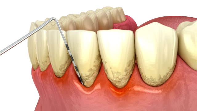 Периодонтит — довольно распространенное стоматологическое заболевание, которое характеризуется воспалением корня зуба и прилегающих мягких тканей. Потенциальная опасность этого недуга высока, если не прибегнуть к своевременному лечению. Не подвергайте себя риску — воспользуйтесь услугами сети клиник «George Group». Мы предлагаем широкий ассортимент стоматологических услуг для пациентов любых возрастов.
