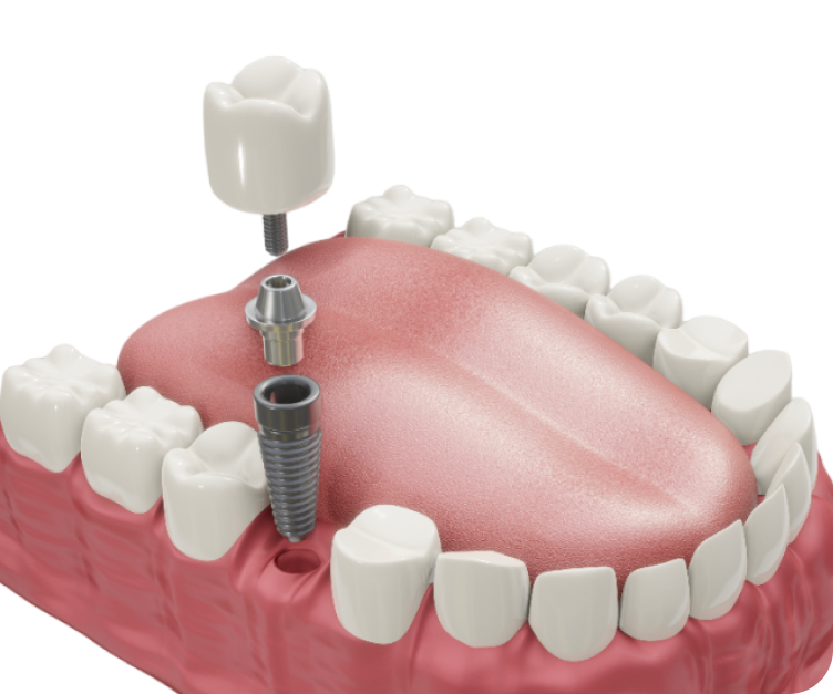 Потеря всего одного зуба может вызвать серьезные последствия, такие как нарушение симметрии лица и прикуса, убывание костной ткани, нарушение пищеварения, а также психологический дискомфорт. Избежать этих последствий можно с помощью своевременной имплантации зубов.<br>
 <br>
Главное — не откладывайте эту процедуру, ведь чем раньше вы обратитесь к специалистам стоматологий George Group, тем быстрее вы вернете себе уверенность в своей улыбке и здоровье полости рта. Современные технологии и материалы позволяют создавать надежные и прочные имплантаты, которые будут служить вам многие годы