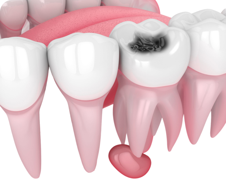 Если вам диагностировали кисту, то 10 лет назад это означало был потерю зуба. Но современная стоматология ушла далеко вперед, а в клиниках George Group работают профессионалы высочайшего уровня, поэтому мы постараемся сохранить ваш зуб!<br>
 <br>
Лечение кисты может быть терапевтическим (требуется стоматолог-терапевт) или хирургическим (требуется хирург-стоматолог).
