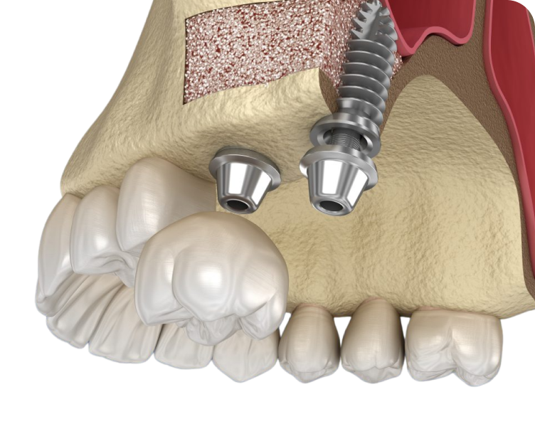 Процедура синус-лифтинг позволяет успешно установить имплантаты зубов в случаях, когда из-за недостатка костной ткани это кажется невозможным. Это инновационная методика в стоматологии, которая позволяет увеличить объем костной ткани в верхней челюсти.<br>
 <br>
Процедура синус-лифтинга в сети клиник George Group безопасна и эффективна, и может быть проведена как во время установки имплантата, так и до нее. Это решение для тех, кто мечтает об идеальной улыбке, но страдает от недостатка костной ткани в верхней челюсти.